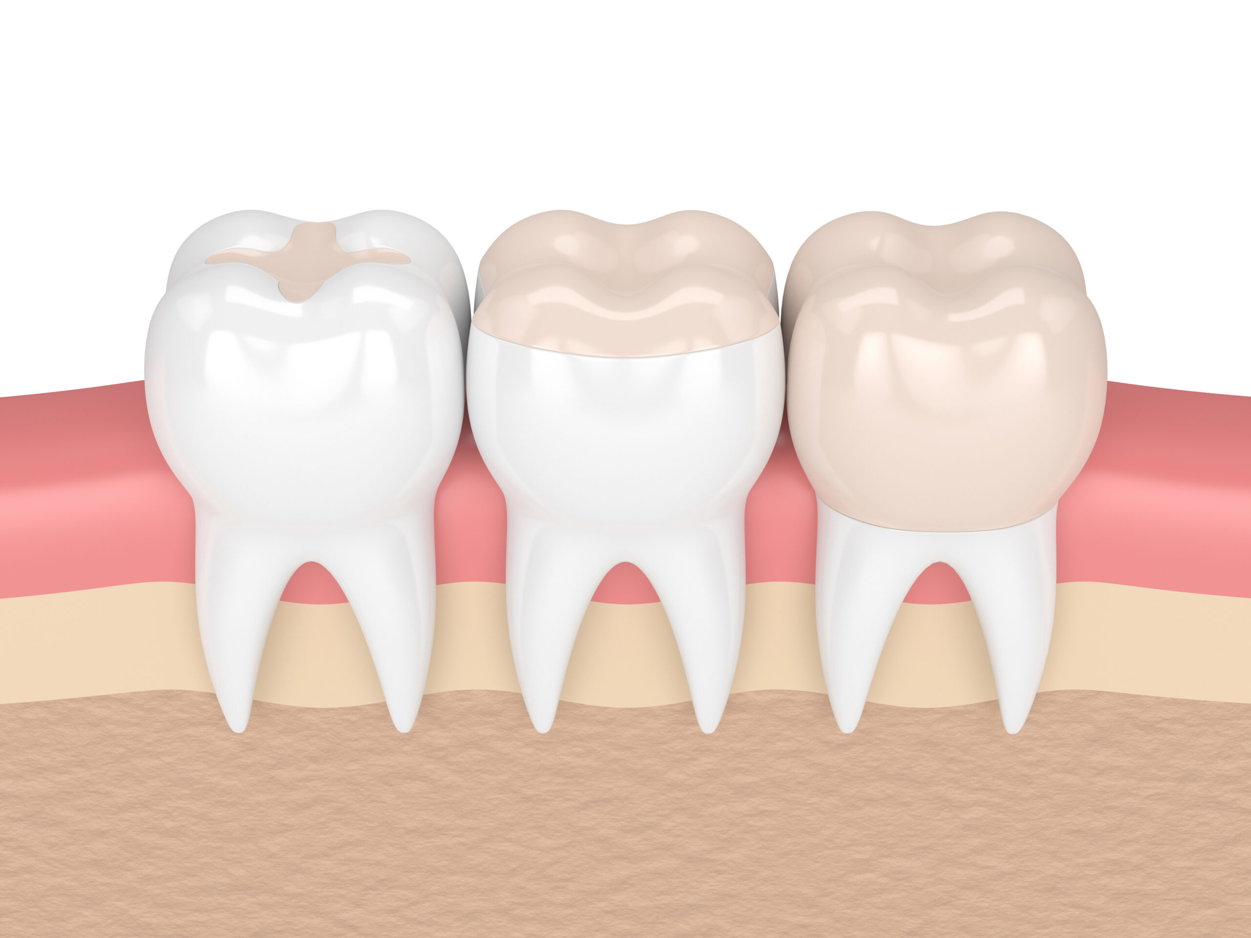 3d render of teeth with different types of filling