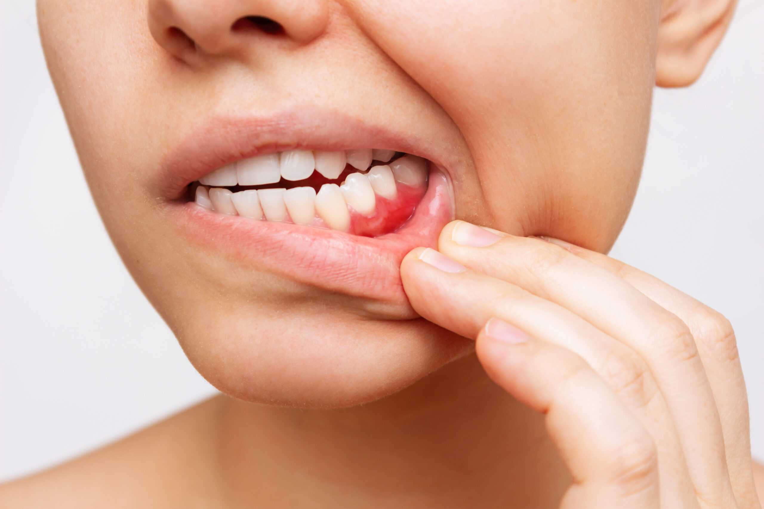 Gum inflammation. Cropped shot of a young woman showing red bleeding gums